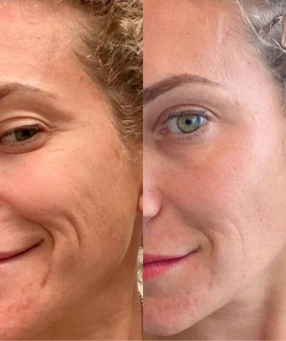 Mouth Wrinkles
