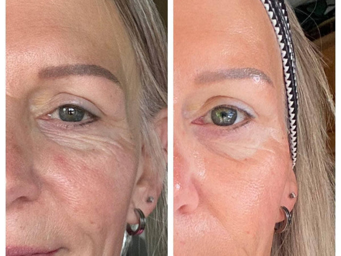 Under Eye Wrinkles