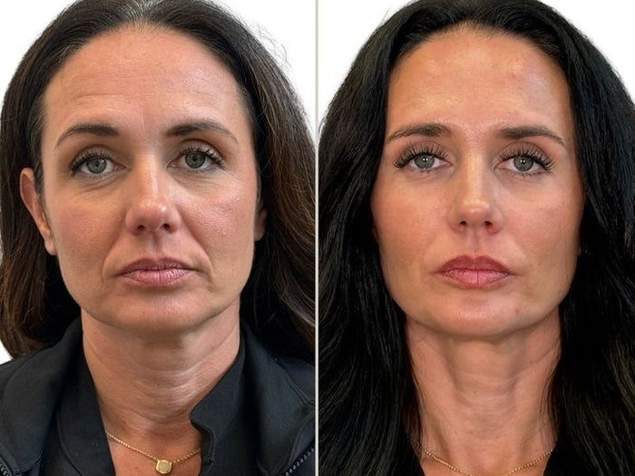 Lower Face Sagging